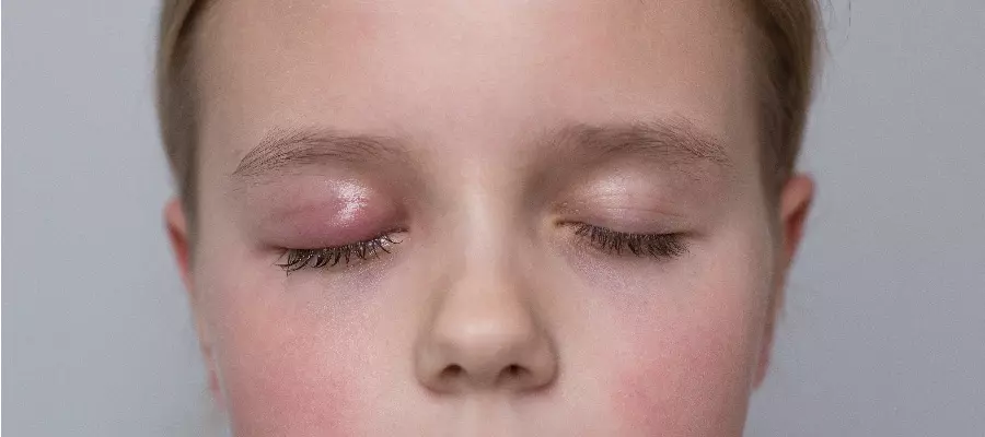 Ячмень на глазу у ребенка - как лечить в домашних условиях